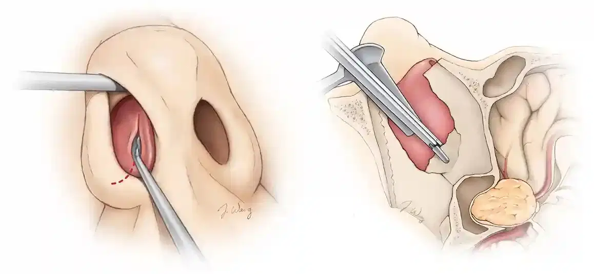 Pituitary Tumor Surgery (Transsphenoidal)