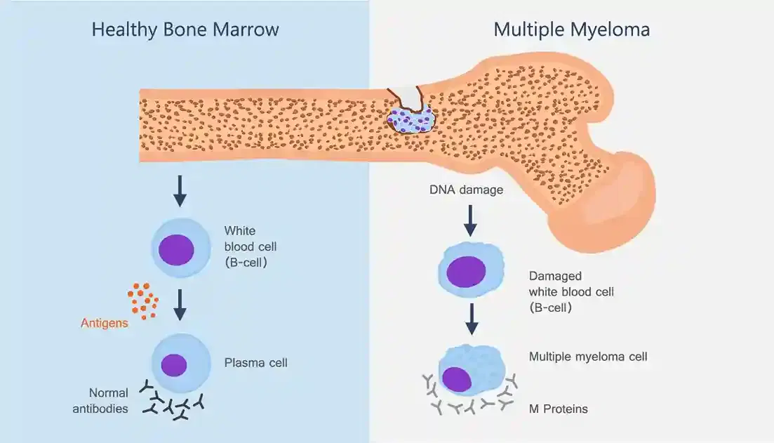 multiple myeloma treatment