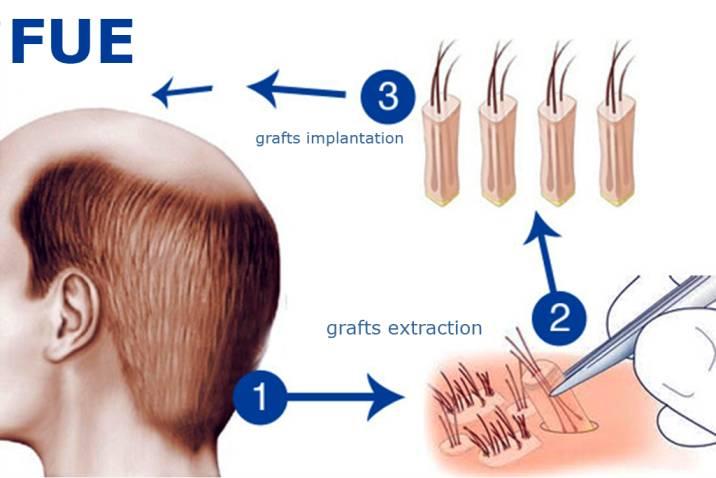 Does Hair Grafting Actually Work? The Honest Answer Does Hair Grafting Actually Work? The Honest Answer