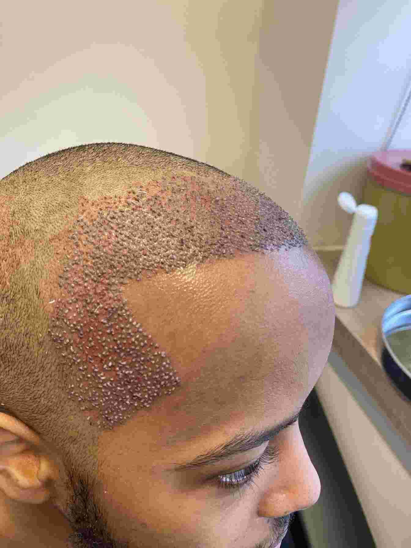 Is a Hair Transplant Permanent? Is a Hair Transplant Permanent?