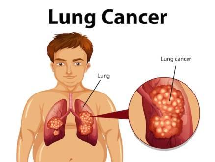 Stage 1 Lung Cancer Surgery: Real Recovery Timeline Stage 1 Lung Cancer Surgery: Real Recovery Timeline