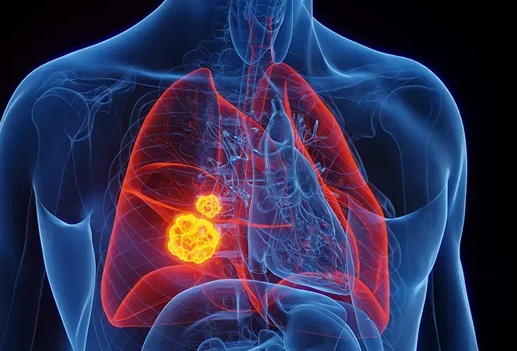 Lung Cancer Symptoms in Women: What's Often Missed Lung Cancer Symptoms in Women: What's Often Missed