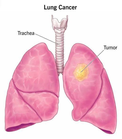 Can You Survive Lung Cancer? Real Survival Rates by Stage Can You Survive Lung Cancer? Real Survival Rates by Stage