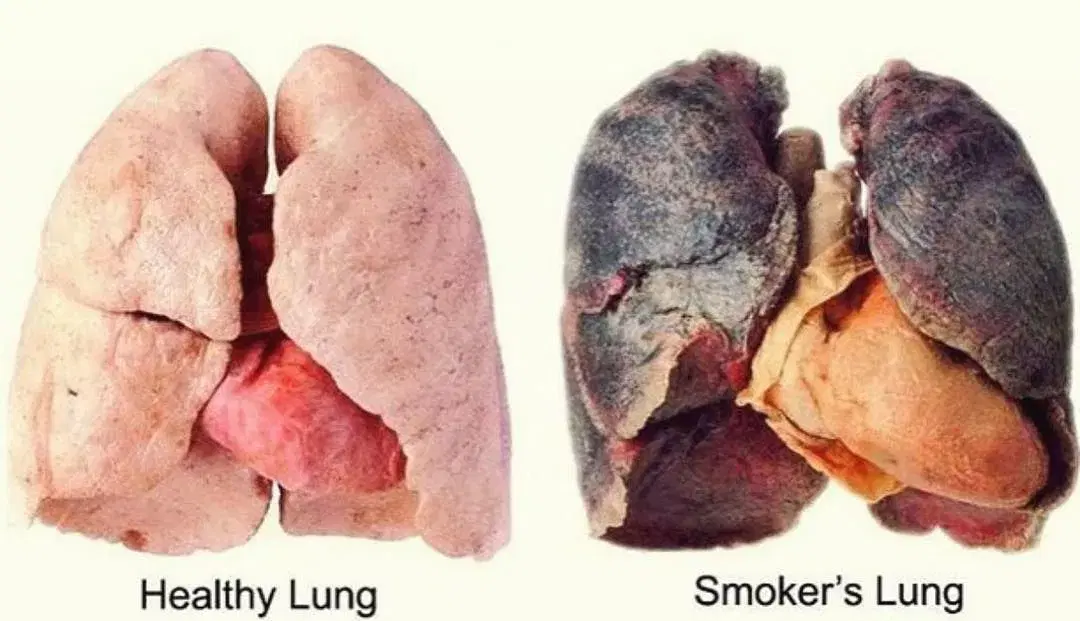 Smoker's Lungs vs Normal Lungs: What Actually Changes Inside Smoker's Lungs vs Normal Lungs: What Actually Changes Inside