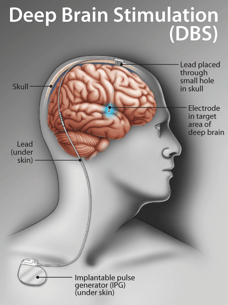 Deep Brain Stimulation (DBS)