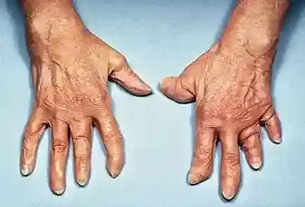 Psoriatic Arthritis Psoriatic Arthritis