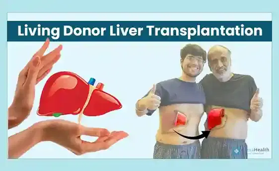 Living Donor Liver Transplant (LDLT) Living Donor Liver Transplant (LDLT)