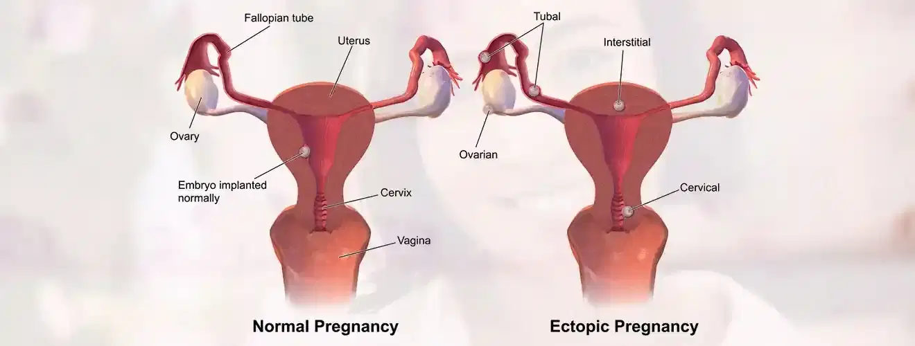 ectopic pregnancy surgery ectopic pregnancy surgery