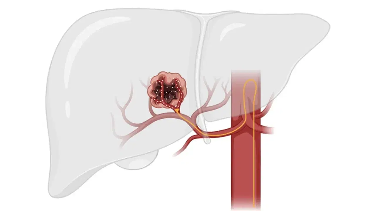 chemoembolization chemoembolization