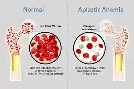 Aplastic Anemia Treatment Program Aplastic Anemia Treatment Program