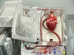Heart Transplant