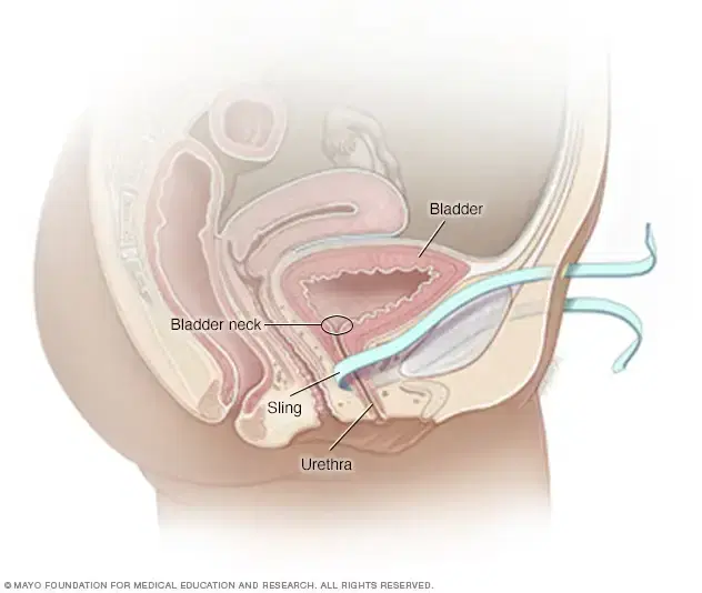 Stress Urinary Incontinence Surgery Stress Urinary Incontinence Surgery