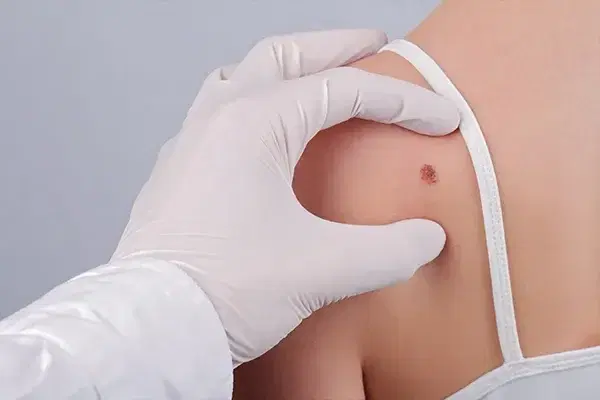 melanoma surgery melanoma surgery