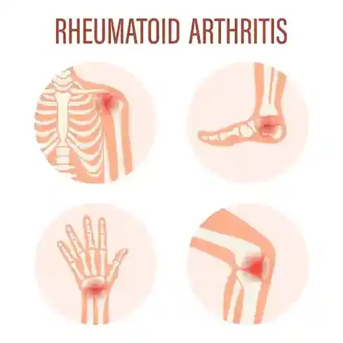 Rheumatoid Arthritis Management Rheumatoid Arthritis Management