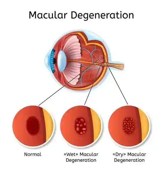 Macular Degeneration Treatment (AMD) Macular Degeneration Treatment (AMD)