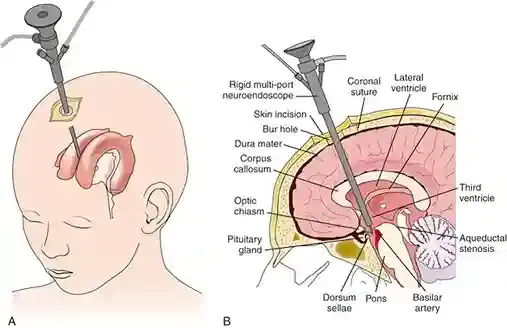 decompressive craniectomy decompressive craniectomy