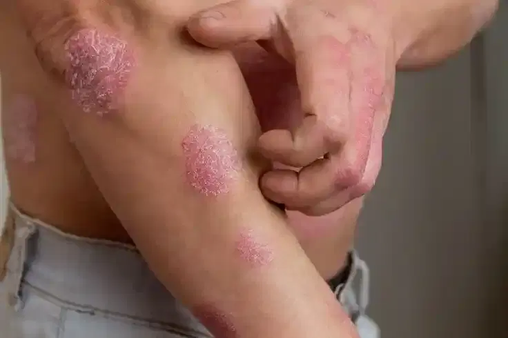 Psoriasis Treatment Psoriasis Treatment