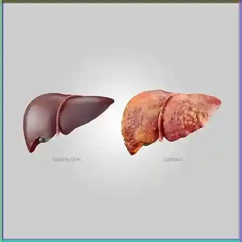Cirrhosis Management Cirrhosis Management