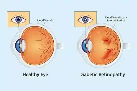 Diabetic Retinopathy Laser / Anti-VEGF Injections Diabetic Retinopathy Laser / Anti-VEGF Injections