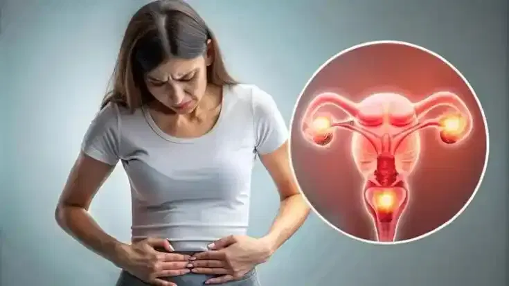 PCOS Management PCOS Management
