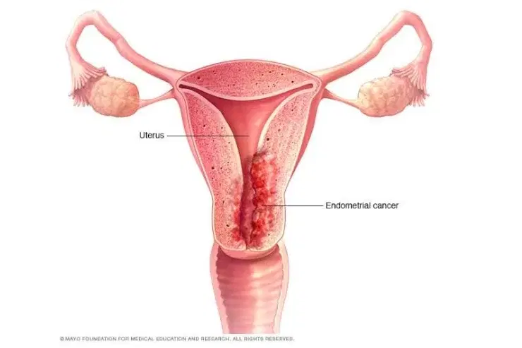 uterine cancer surgery uterine cancer surgery