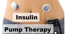 Insulin Pump Therapy Insulin Pump Therapy