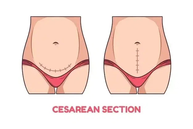 Cesarean Section (C-Section) Cesarean Section (C-Section)