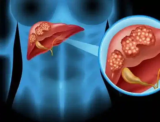 Liver Cancer Screening Liver Cancer Screening