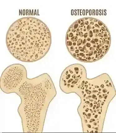 Bone Health & Osteoporosis Bone Health & Osteoporosis