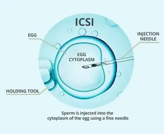 ICSI (Intracytoplasmic Sperm Injection) ICSI (Intracytoplasmic Sperm Injection)