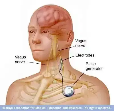 Vagus Nerve Stimulation (VNS) Implant Vagus Nerve Stimulation (VNS) Implant
