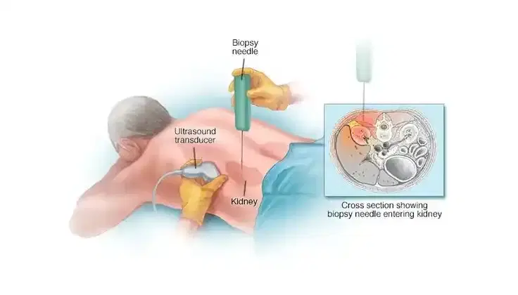 Kidney Biopsy Kidney Biopsy