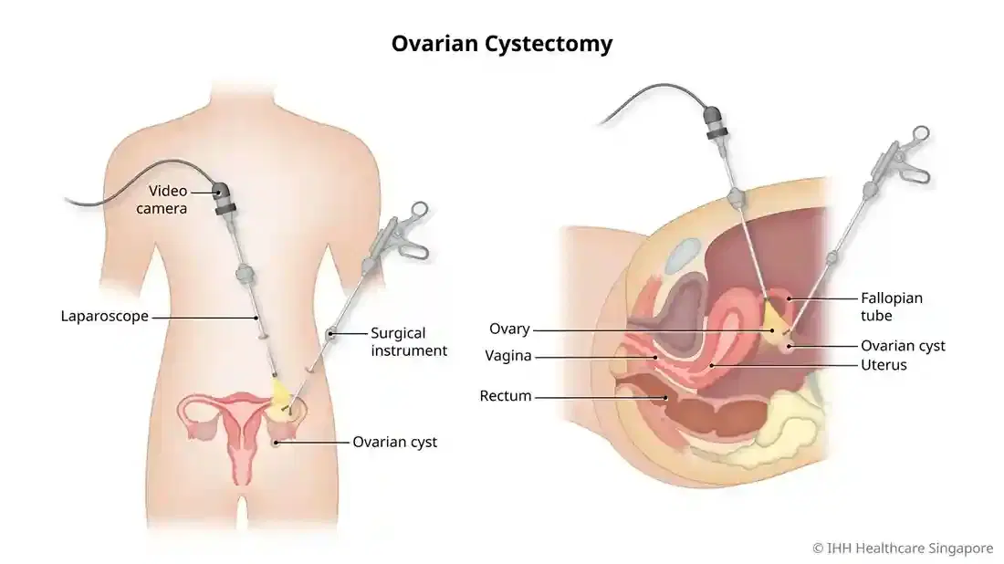ovarian cystectomy ovarian cystectomy