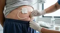 Peritoneal Dialysis Peritoneal Dialysis