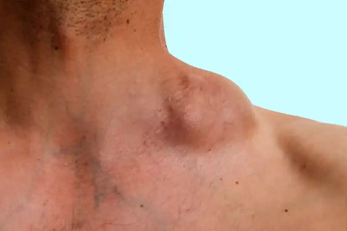 lymphoma treatment lymphoma treatment