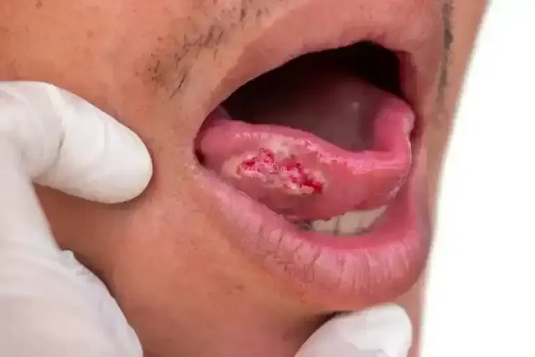 oral cancer surgery oral cancer surgery