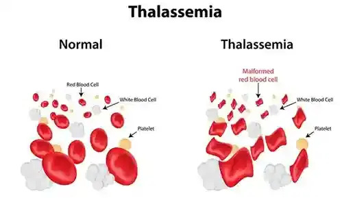 Thalassemia Management Program Thalassemia Management Program