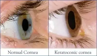 Keratoconus Treatment (CXL / Rings) Keratoconus Treatment (CXL / Rings)