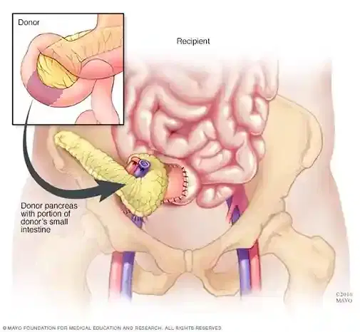 Pancreas Transplant (select centers) Pancreas Transplant (select centers)