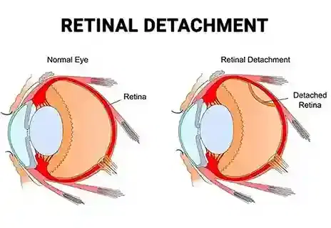 Retinal Detachment Repair Retinal Detachment Repair