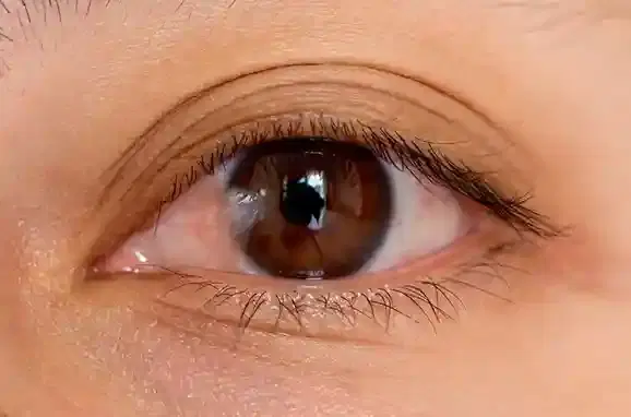 Pterygium Surgery Pterygium Surgery