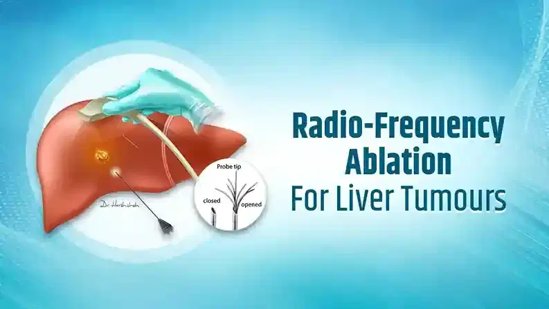 radiofrequency ablation cancer radiofrequency ablation cancer