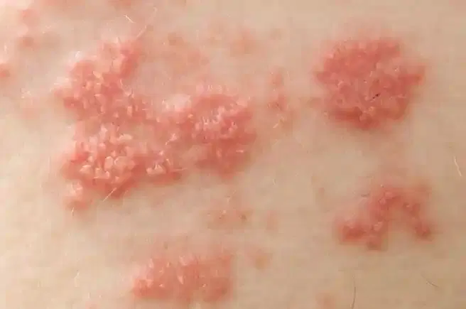 Eczema / Atopic Dermatitis Management Eczema / Atopic Dermatitis Management