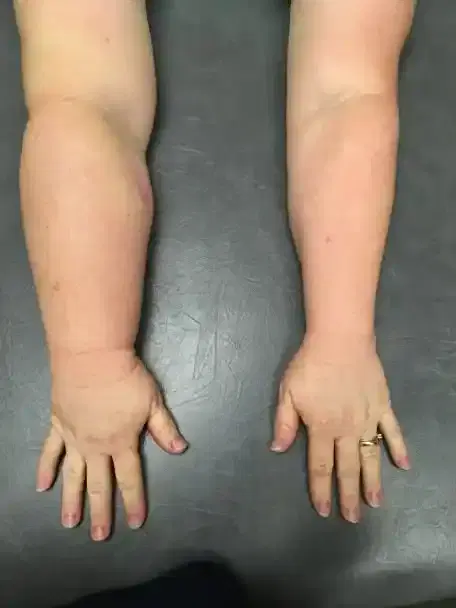 Lymphedema Treatment Lymphedema Treatment