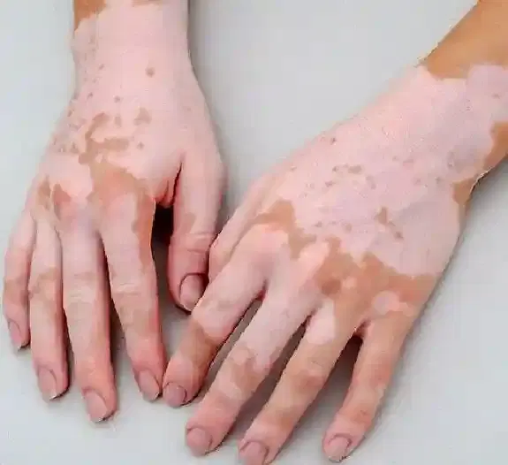 Vitiligo Treatment Vitiligo Treatment