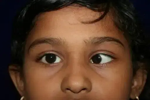 Pediatric Squint Surgery Pediatric Squint Surgery