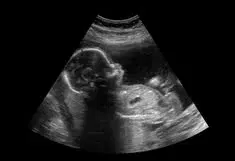 Anomaly Scan (Level II Ultrasound) Anomaly Scan (Level II Ultrasound)