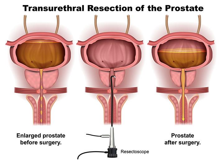 TURP (Transurethral Resection of Prostate)