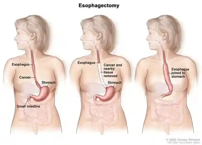 Esophageal Cancer Surgery Esophageal Cancer Surgery