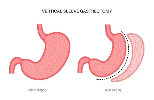 Sleeve Gastrectomy (Gastric Sleeve) Sleeve Gastrectomy (Gastric Sleeve)